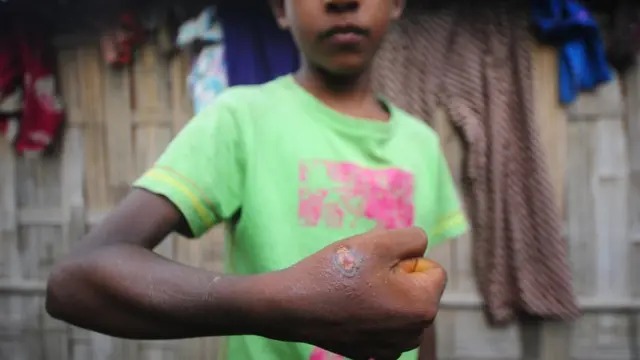 অ্যানথ্রাক্স আক্রন্তা একজন কিশোর (ফাইল ছবি)